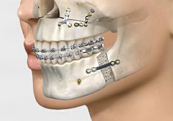 Ortodoncia prequirúrgica
