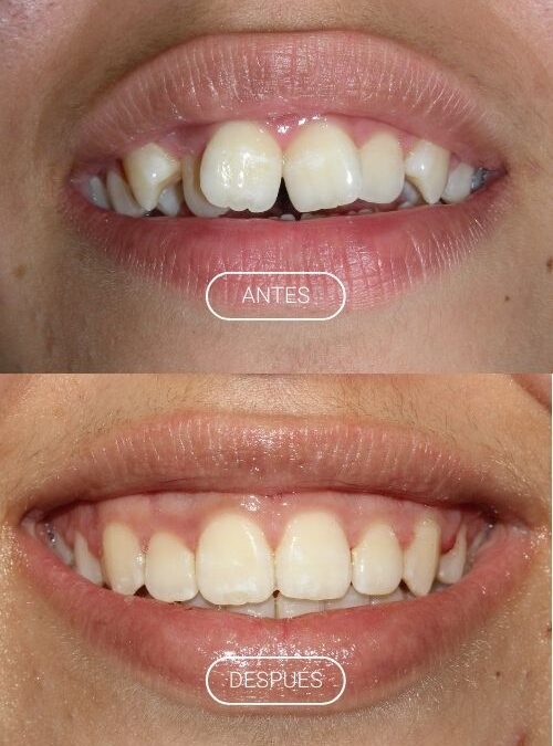 APARATOLOGÍA FIJA. BRACKETS METÁLICOS.