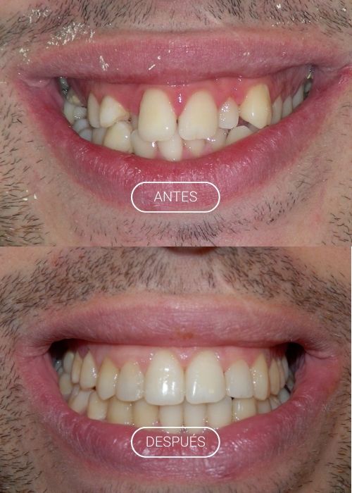 apinamiento
