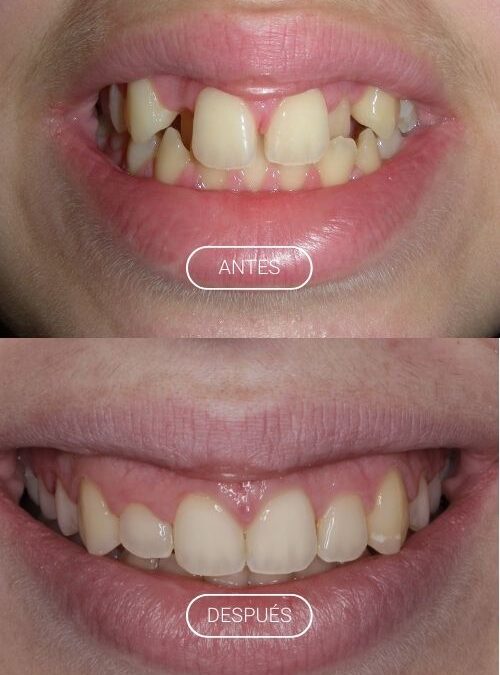 APARATOLOGÍA FIJA. BRACKETS METÁLICOS AUTOLIGABLES.
