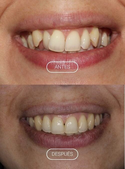 APARATOLOGÍA FIJA. BRACKETS METÁLICOS Y MICROTORNILLOS.