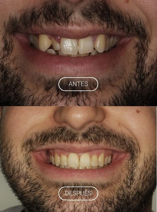 APARATOLOGÍA FIJA. BRACKETS METÁLICOS. 
